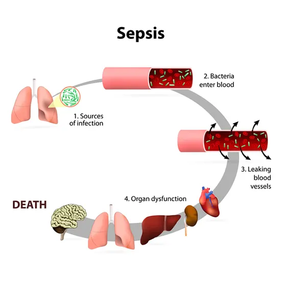 galactose (classical) test